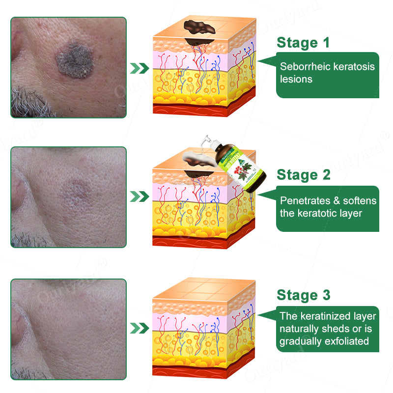 💖✨Ourlyard® 3X Concentrated, 100% Pure Castor Oil – Relieves Dry, Flaky, Itchy Skin, Seborrheic Keratosis, and Eczema