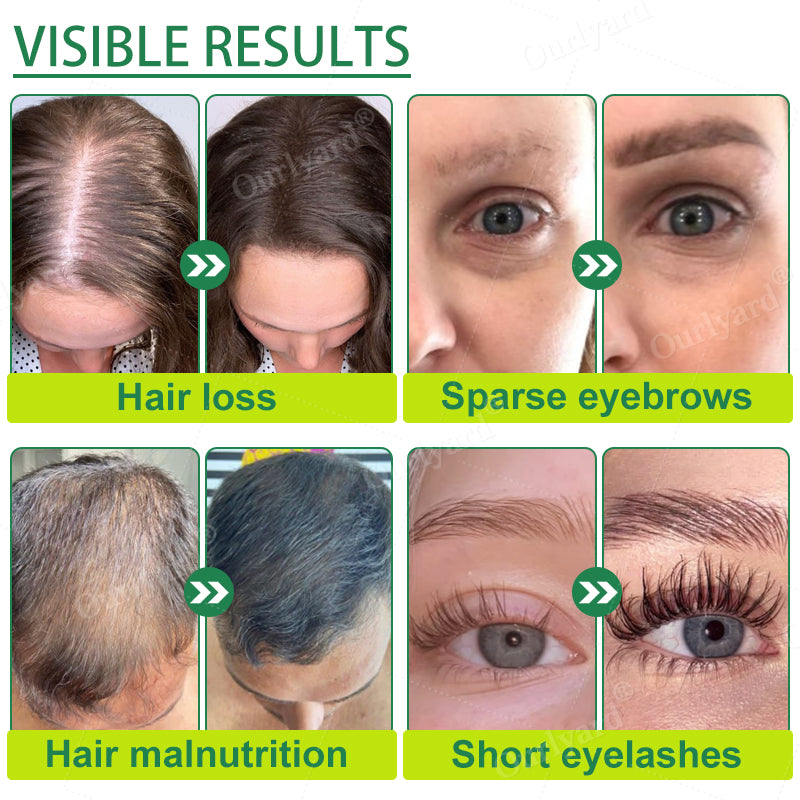 💖💖Ourlyard® 3X Concentrated Castor Oil – Australian Certified Organic, 100% Pure & Cold Pressed. Boosts Hair Growth for Thicker, Fuller Hair, Lashes & Brows.